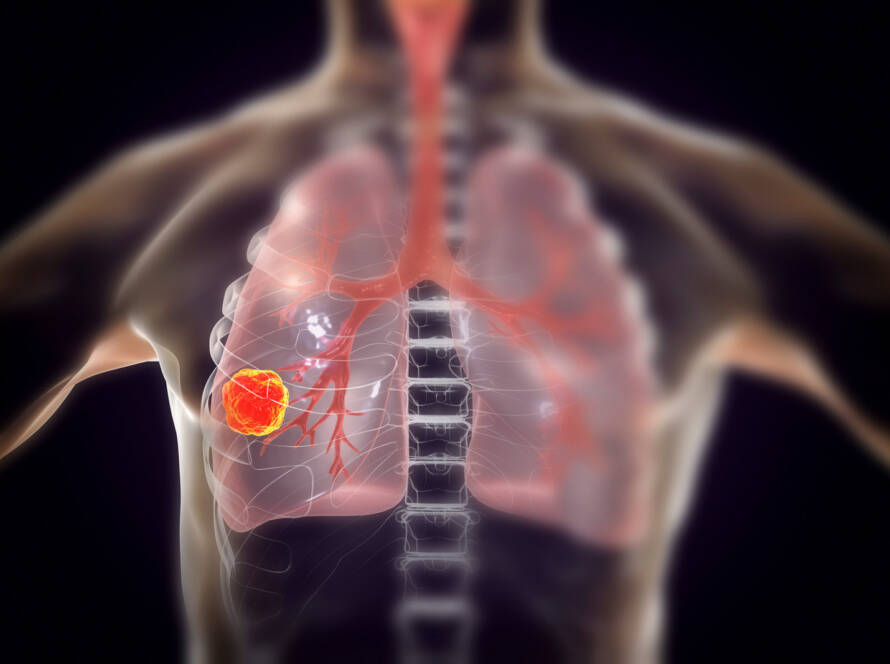 Imagen ilustrada con los efectos del amianto en la salud Viso Amianto
