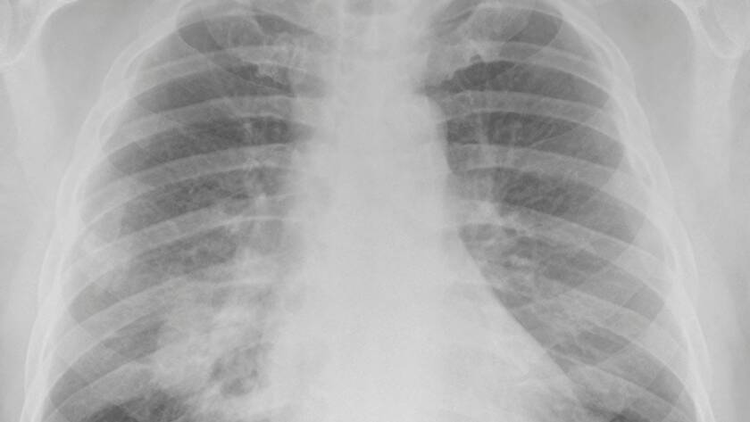 Radiografía con los efectos del amianto en la salud Viso Amianto