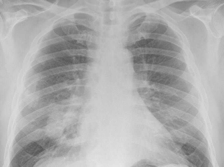 Radiografía con los efectos del amianto en la salud Viso Amianto